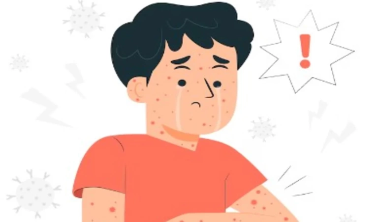 Monkeypox Merajalela, Segera Cegah dengan Lakukan Ini!